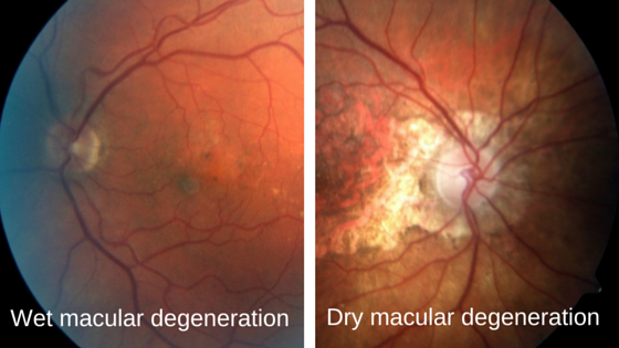 Types of Macular Degeneration