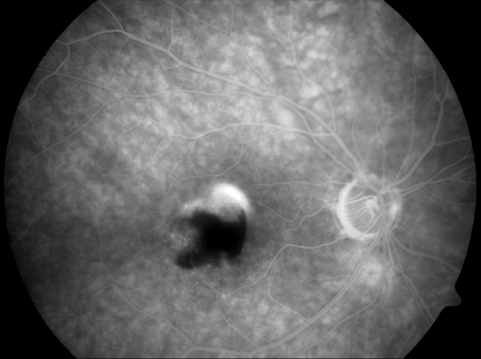Intravenous Fluorescein Angiography of Age Related Macular Degeneration Wet