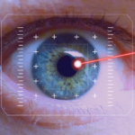 Laser Treatments for Eye Conditions