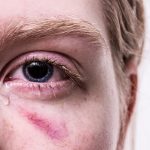 eye injury